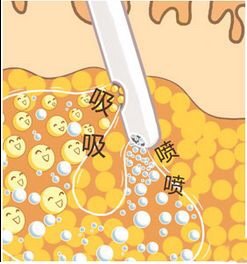 【脂肪分布】脂肪在人体中是一部分比较特殊的组织,它