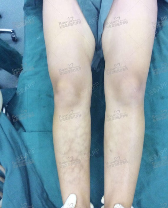 手术方案:抽取大腿以及腰腹部的脂肪,进行填充双腿膝盖内侧凹陷的部位