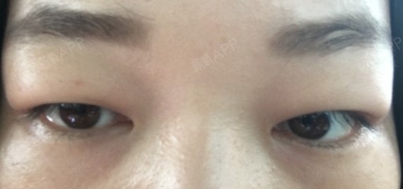 我是超级肉眼泡.想做个双眼皮,做了好多功课也