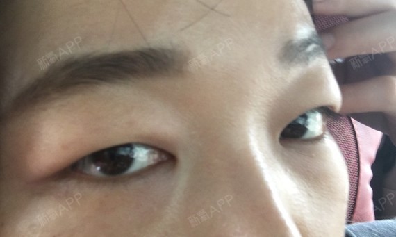 我是超级肉眼泡.想做个双眼皮,做了好多功课也