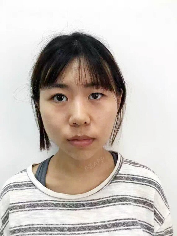 这是我手术之前的照片 一大眼一小眼 太明显了 和手术之后