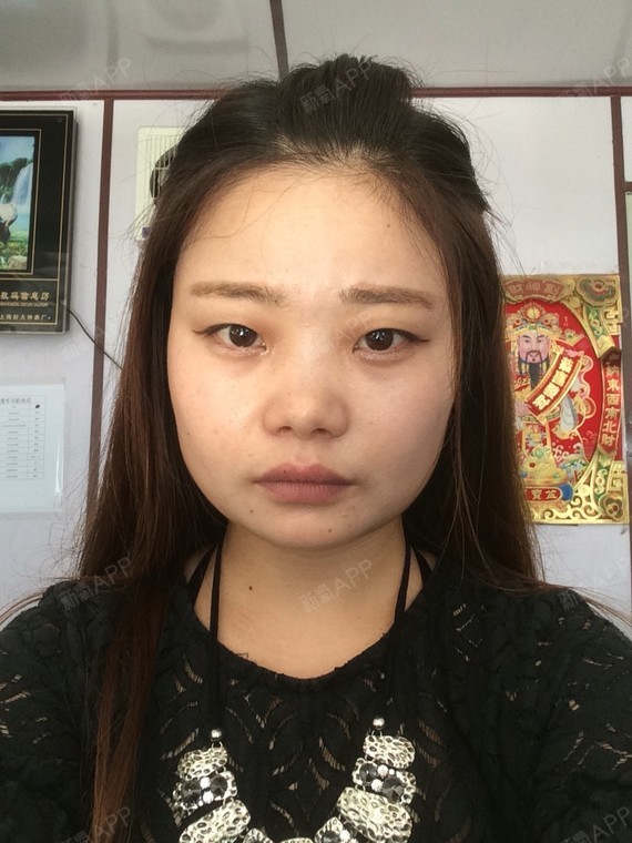 新氧-哒哒滴水|毒素轮廓|瘦脸|肉腰部瘦脸|微整形|肉毒素如何减面部的脂肪图片
