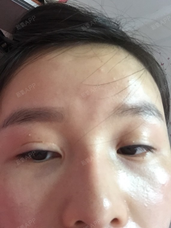医生我这眼睛11年做的全切开的有疤痕
