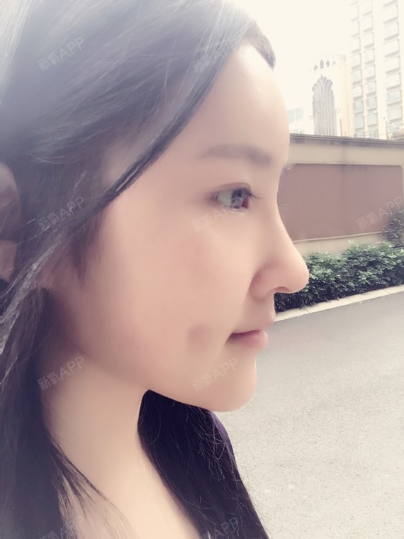 大萌仔酒窝成形术术后第21天美丽日记_新氧整形