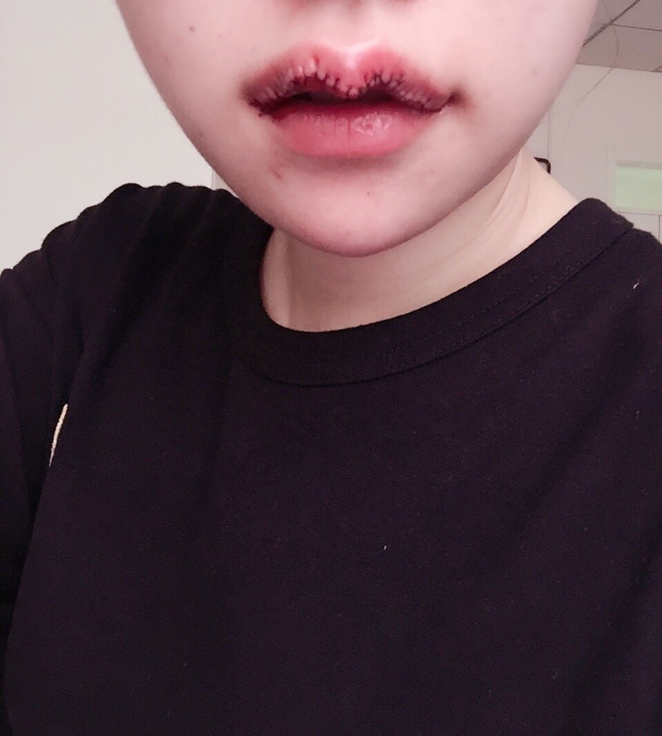 m唇手术第0天