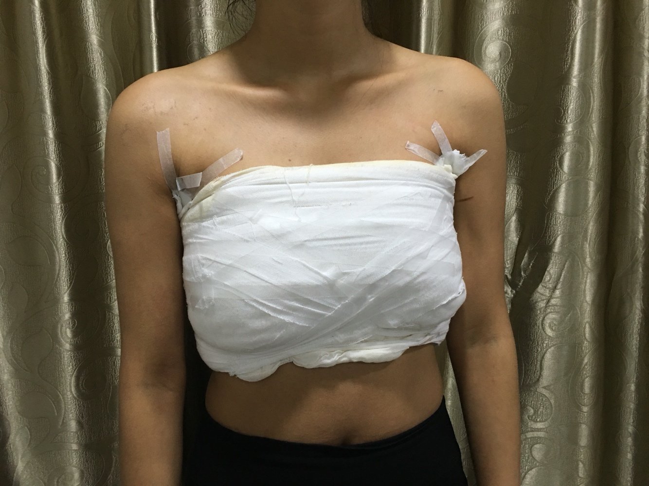 假体隆胸第4天