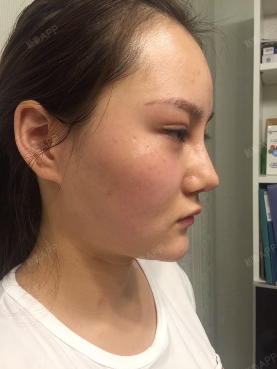 在别家医院嘴唇打的上唇突出,下唇太憋,我嘴巴天生很