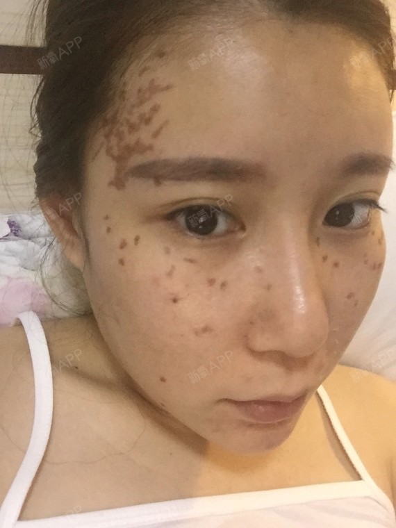激光点痣