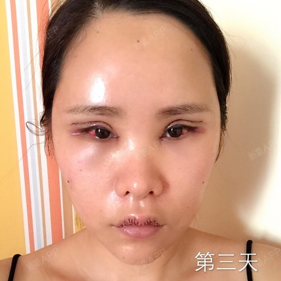 自体脂肪面部填充