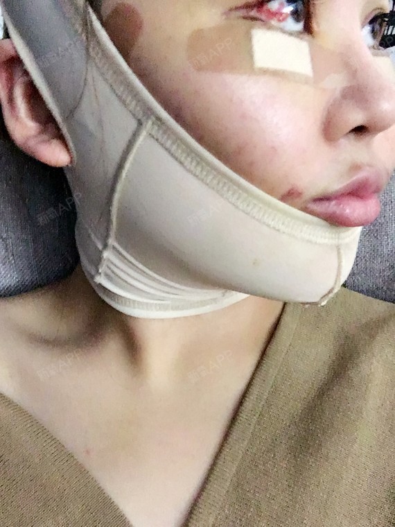 磨下颌骨内推颚骨已经一周左右