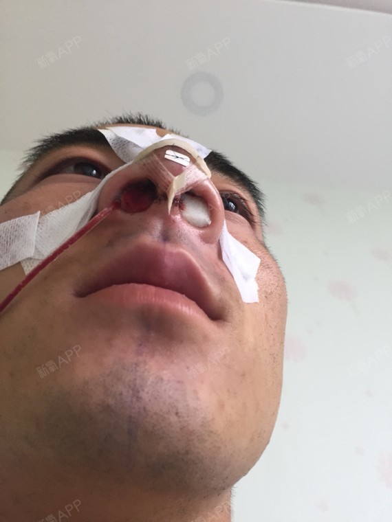 术后当自强|国内整形|鼻骨矫正|驼峰鼻矫正|男生整形|鼻
