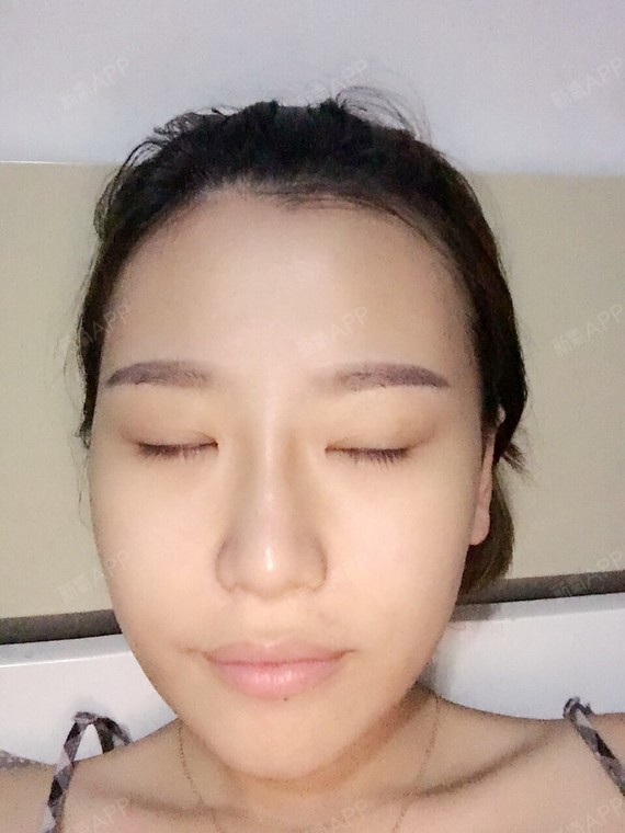 ... | 术后当自强 | 国内整形 | 福州同城 | 皮肤 | 水光针