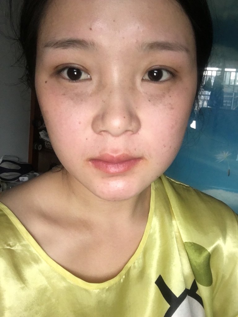 我也想去做,我的眼部黑色素比较严重,不知道做那个项目