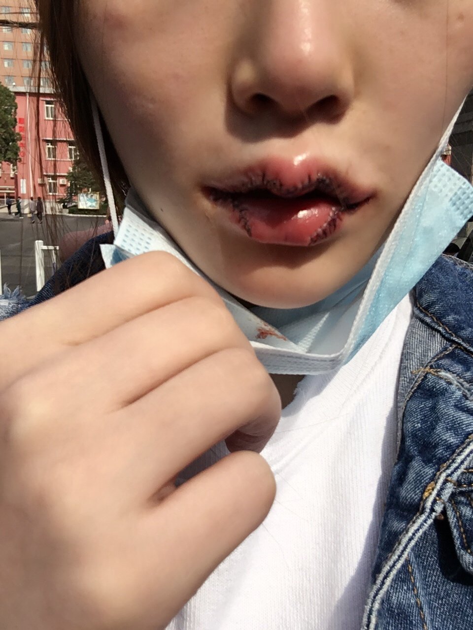 m唇手术第0天