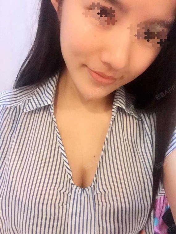 新氧- 胖木子 | 胸部 | 自体脂肪隆胸 | 术后当自强 | 国内整形