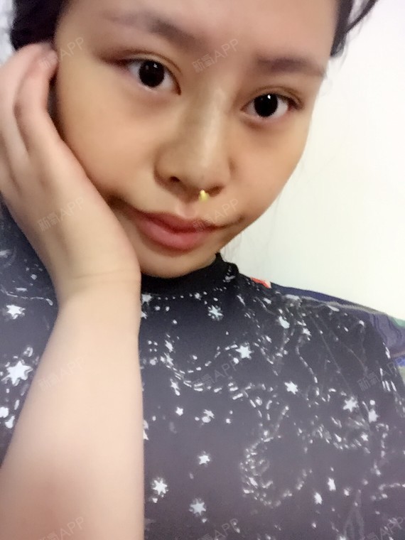 熊颖颖硅胶隆鼻术后第天美丽日记_新氧整形