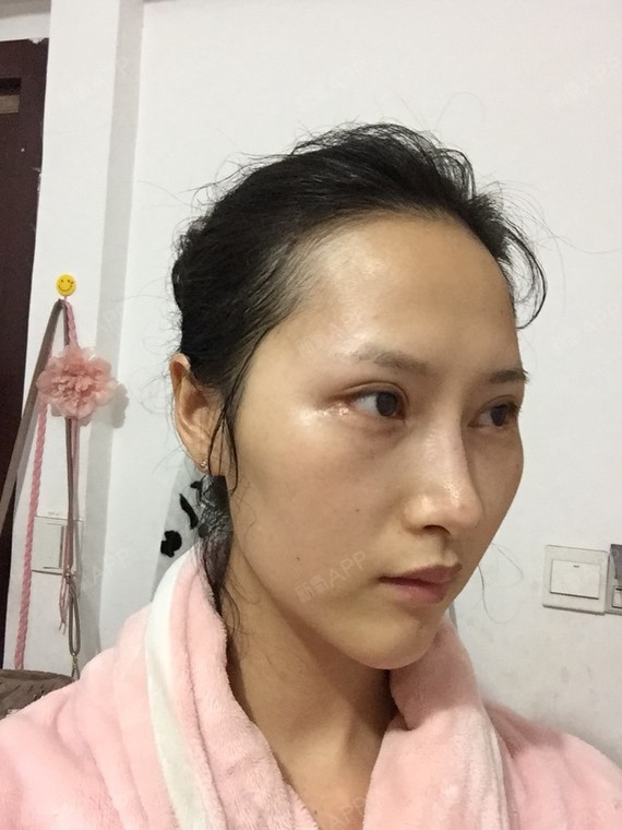 新氧昵称:外眼角年龄:23身高:165体重:90～92职业:销售希望手术项目