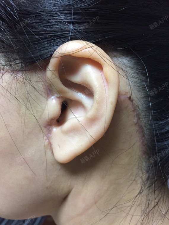 切口从太阳穴沿着耳朵一直到耳后的发际线的位置,整一个月了还肿着