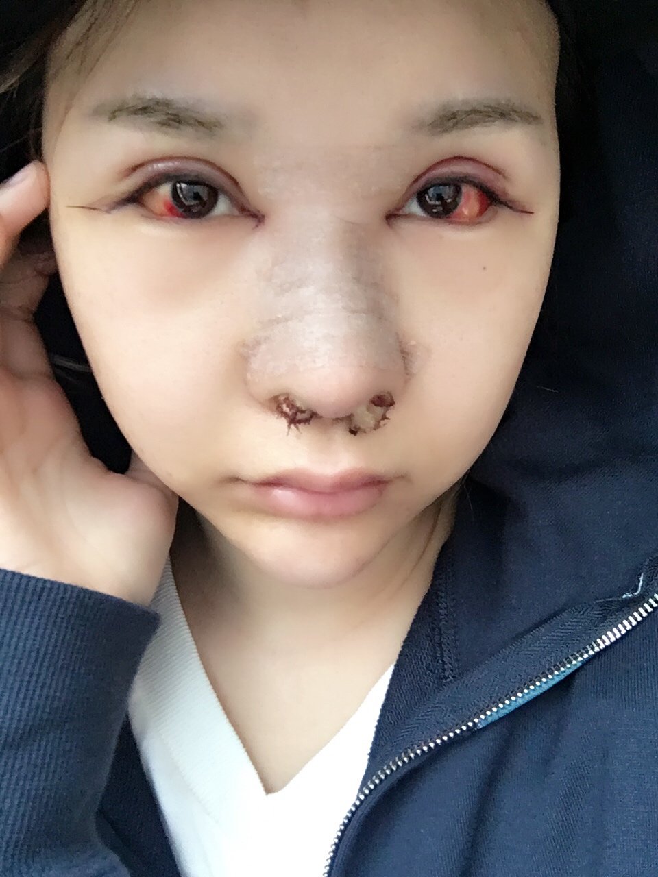 开内眼角第2天