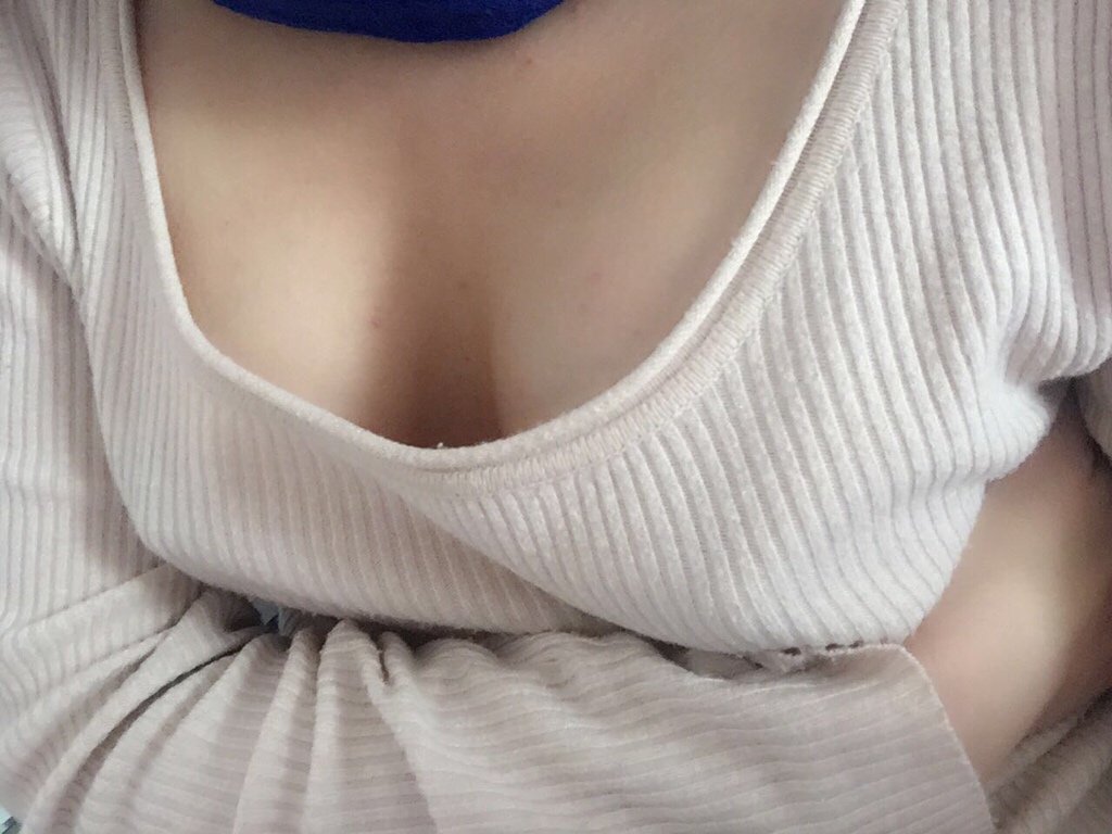 假体隆胸第38天