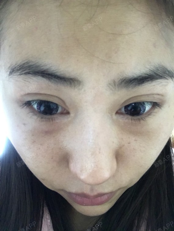 水光针