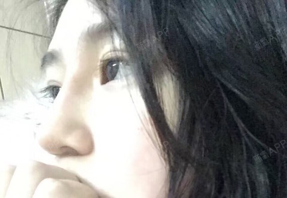 鼻根还是有点红粗希望是还没恢复吧(1)希腊鼻:维纳斯的鼻子就是