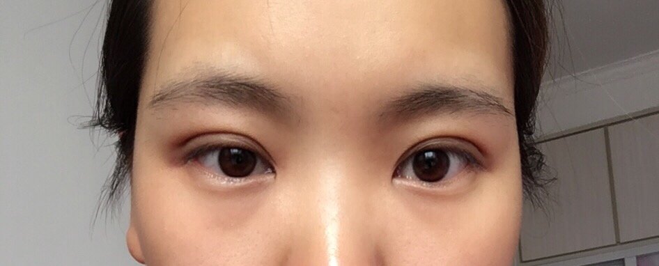 医生,刚做1个月埋线,左右不对称,左边挡眼睛,需要修复嘛