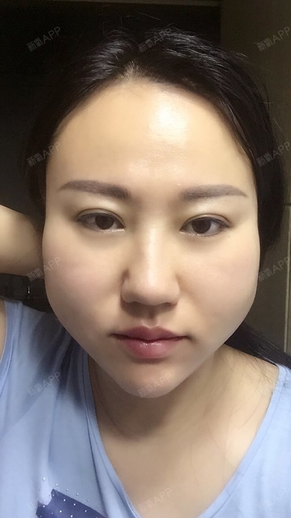 取颊脂垫瘦脸好不好_效果图_poresky取颊脂垫瘦脸术后