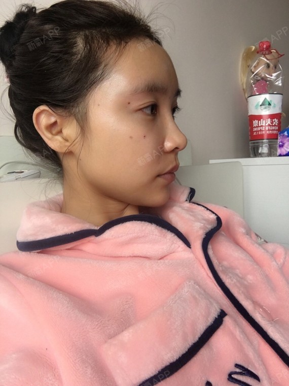 这个疼痛度是我做过最疼的了,抽脂的时候疼哭了.局部