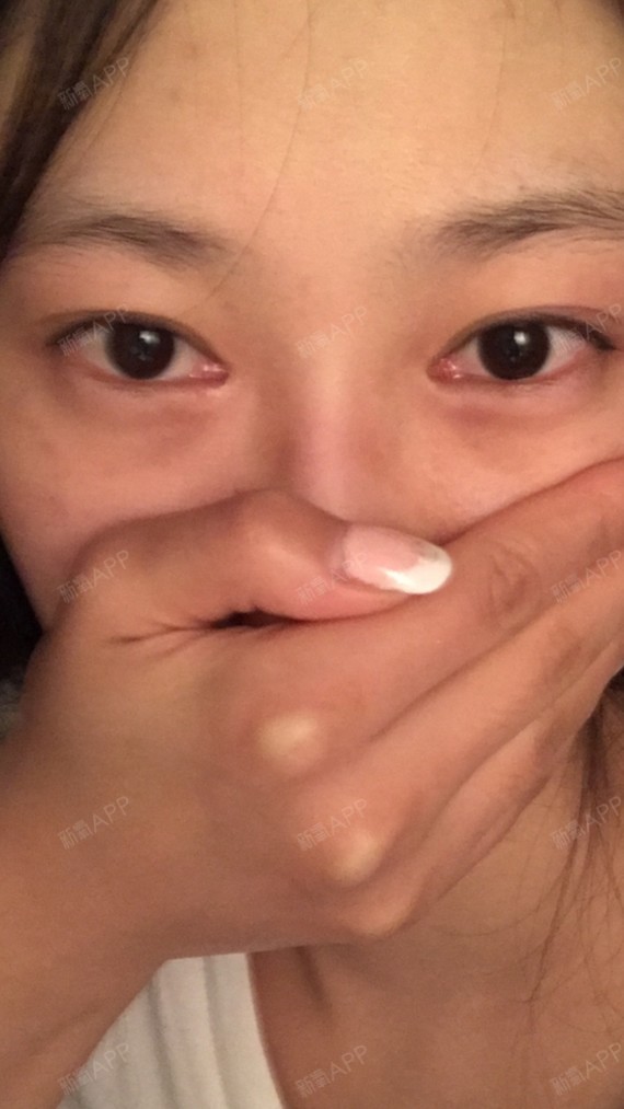 眼修复】内眼角失败二级修复解决内眼角疤痕过大圆钝泪阜暴露过多下沉