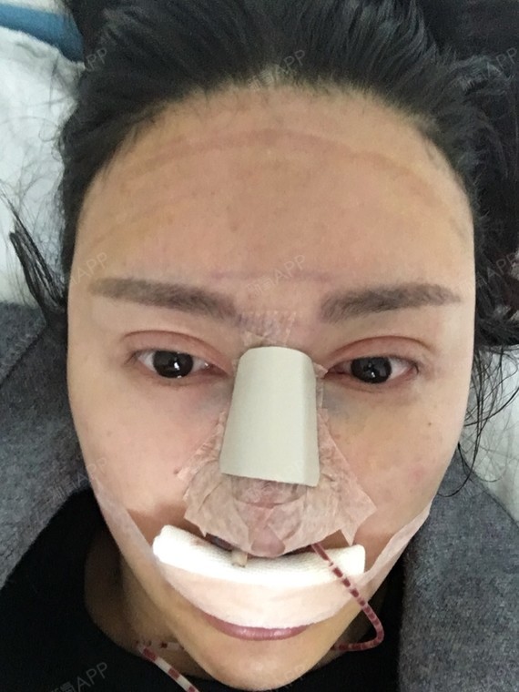 鼻翼|自体软骨垫鼻尖|宽鼻矫正|鼻骨矫正|鼻部修复|手术