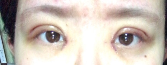 涂了一点点红霉素眼膏 眼角那里明显红肿
