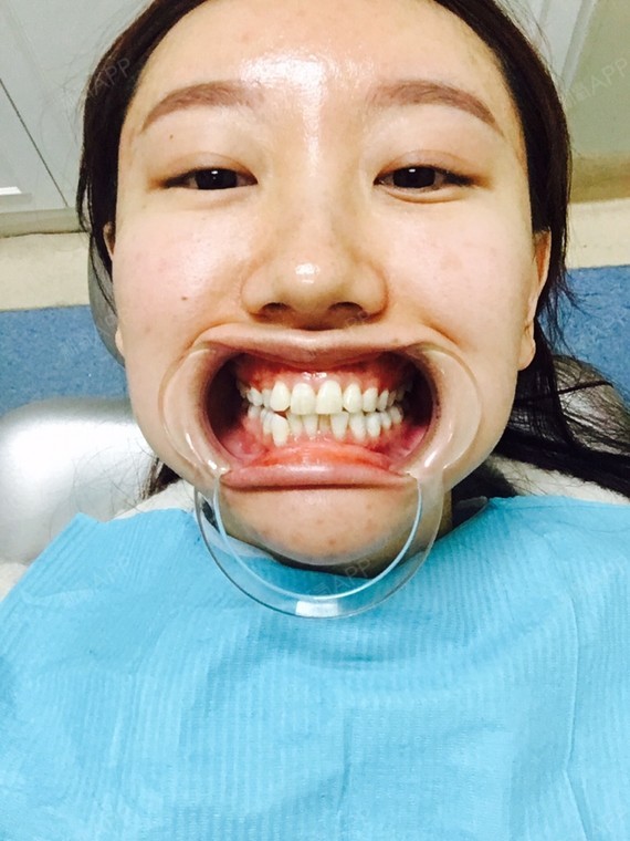 总之特别满意…就是什么时候才能不疼啊 现在喝热水冷水都好痛苦!