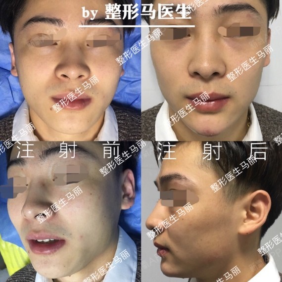 两个多星期玻尿酸注射下巴 咬肌肉毒注射效果