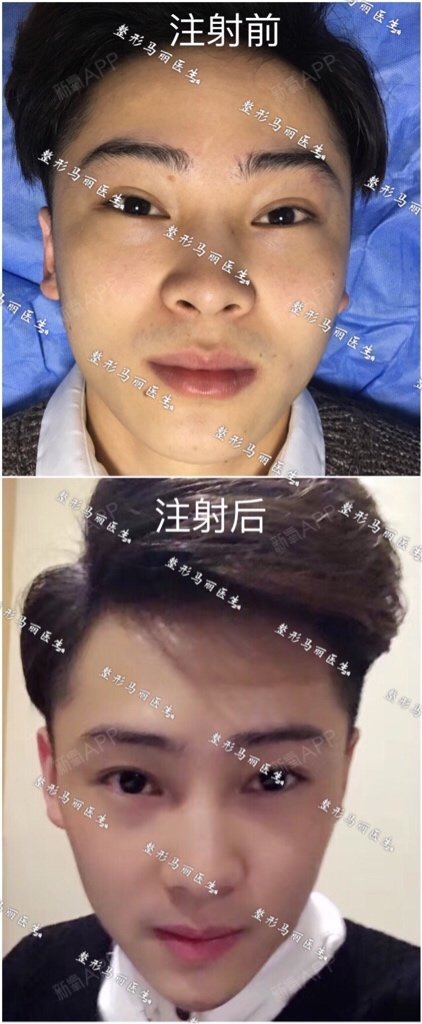 两个多星期玻尿酸注射下巴 咬肌肉毒注射效果