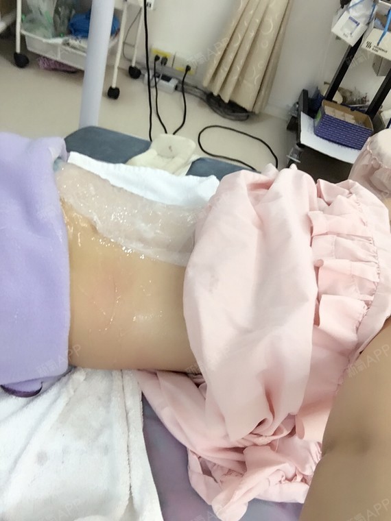 林虹伶冷冻溶脂瘦腰部第0天美丽日记
