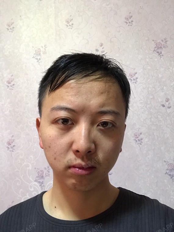 近视多年,眼球轴距过长,外突明显,正面看不出来,侧