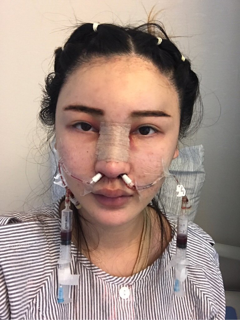 耳软骨复合隆鼻第1天