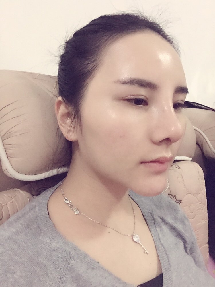 耳软骨复合隆鼻怎么样_恢复过程_效果如何_chenweiju.