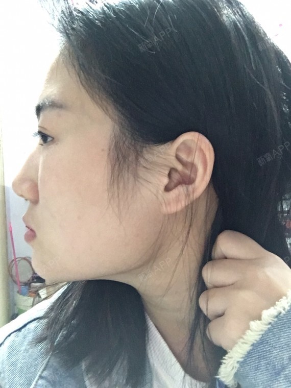 从小就自己的下颚角就成了一块心病,不敢扎头发,天天披着,后来长大了