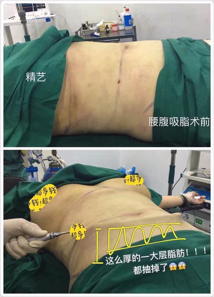 吸脂瘦腹部第12天