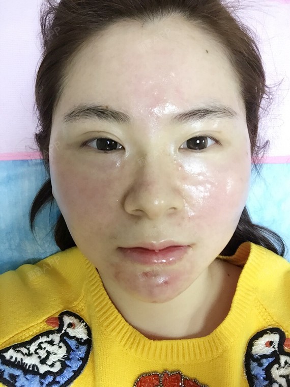 ... 达人花君 | 术后当自强 | 国内整形 | 皮肤 | 水光针