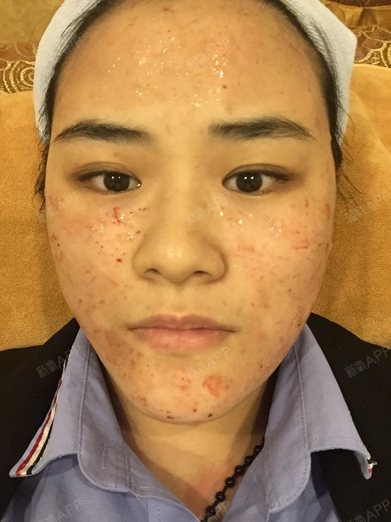... | 微整形 | 术后当自强 | 广州同城 | 皮肤 | 水光针
