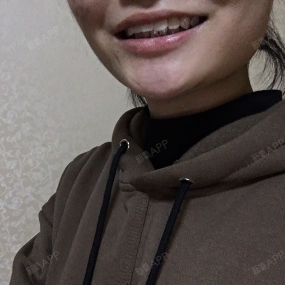 脸部完全放松会有严重的天包地,而且会没有下巴,牙齿_圈子-新氧美容