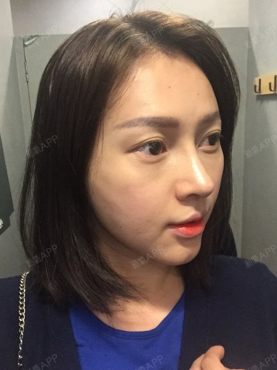 【颧骨术后遗症-面部凹凸不平求修复方法】