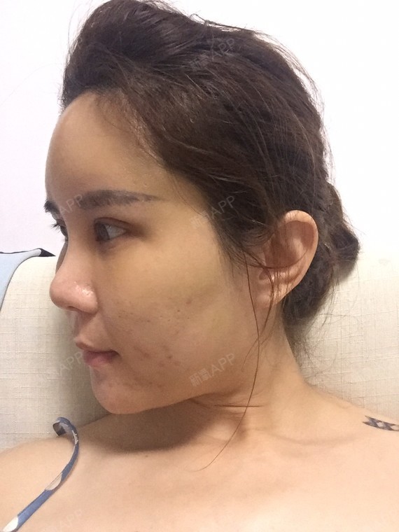 玛莉莲梦兔自体脂肪填充脸颊第11天美丽日记