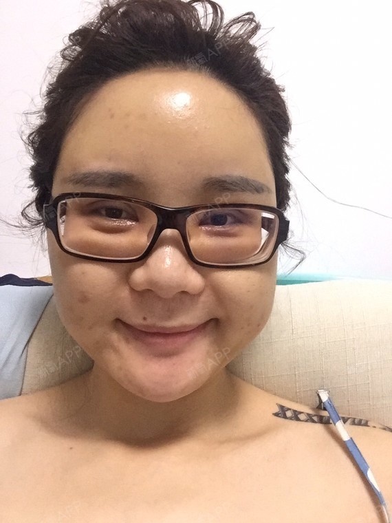 玛莉莲梦兔自体脂肪填充脸颊第11天美丽日记