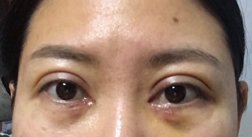 开内眼角怎么样_恢复过程_效果如何_大连女孩整形日记