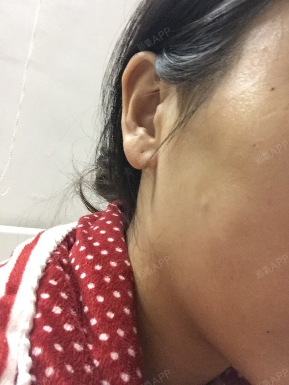 埋蛋白线和脂肪填充面颊,已经20天了,发现右边鼓了