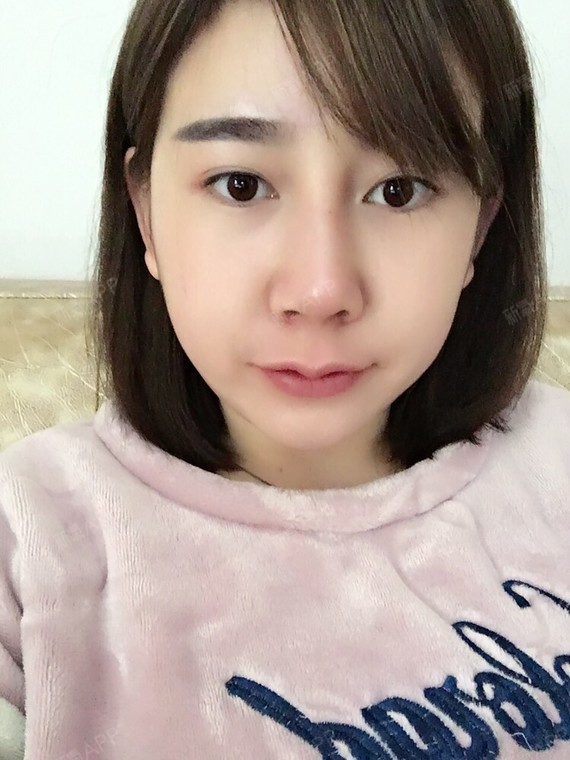 报名假体隆胸韩国爱我整形医院。自己本身做过